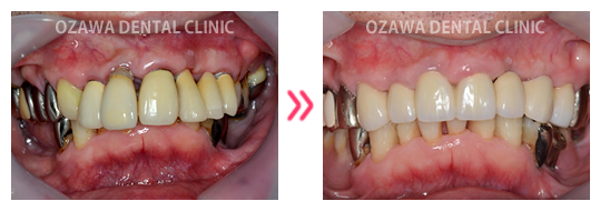 審美歯科 症例ケース04