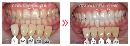 ホワイトニング 症例ケース01