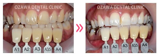 ホワイトニング 症例ケース02
