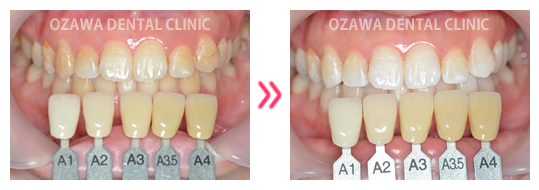 ホワイトニング 症例ケース03