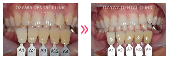 審美歯科 症例ケース02