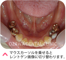 インプラント（臼歯）ケース１　治療前