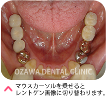 インプラント（臼歯）ケース１　治療跡