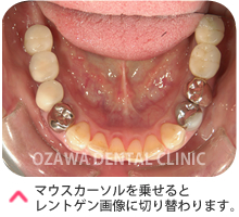 インプラント（臼歯）ケース１　３年後