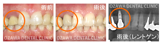 インプラント（前歯）術前・術後・術後のレントゲン