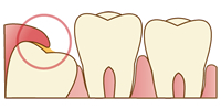 口腔外科イラスト：歯ぐきがかぶっている