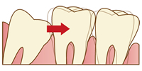 口腔外科イラスト：隣の歯を押している